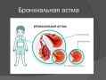 Аллергическая бронхиальная астма – одна из самых распространённых форм астмы